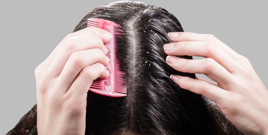 száraz fejbőr hajhullás pikkelysömör szokatlan kezelések